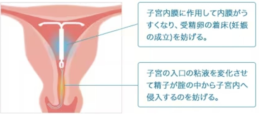 子宮内黄体ホルモン放出システム（IUS ミレーナ®）